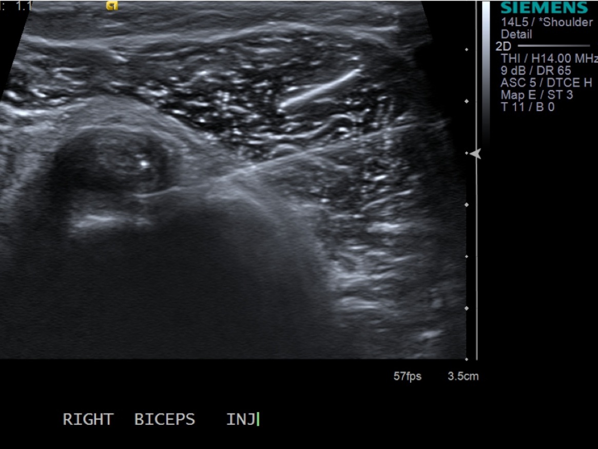 Biceps Tendon Sheath Injection — MSK Ultrasound Procedures