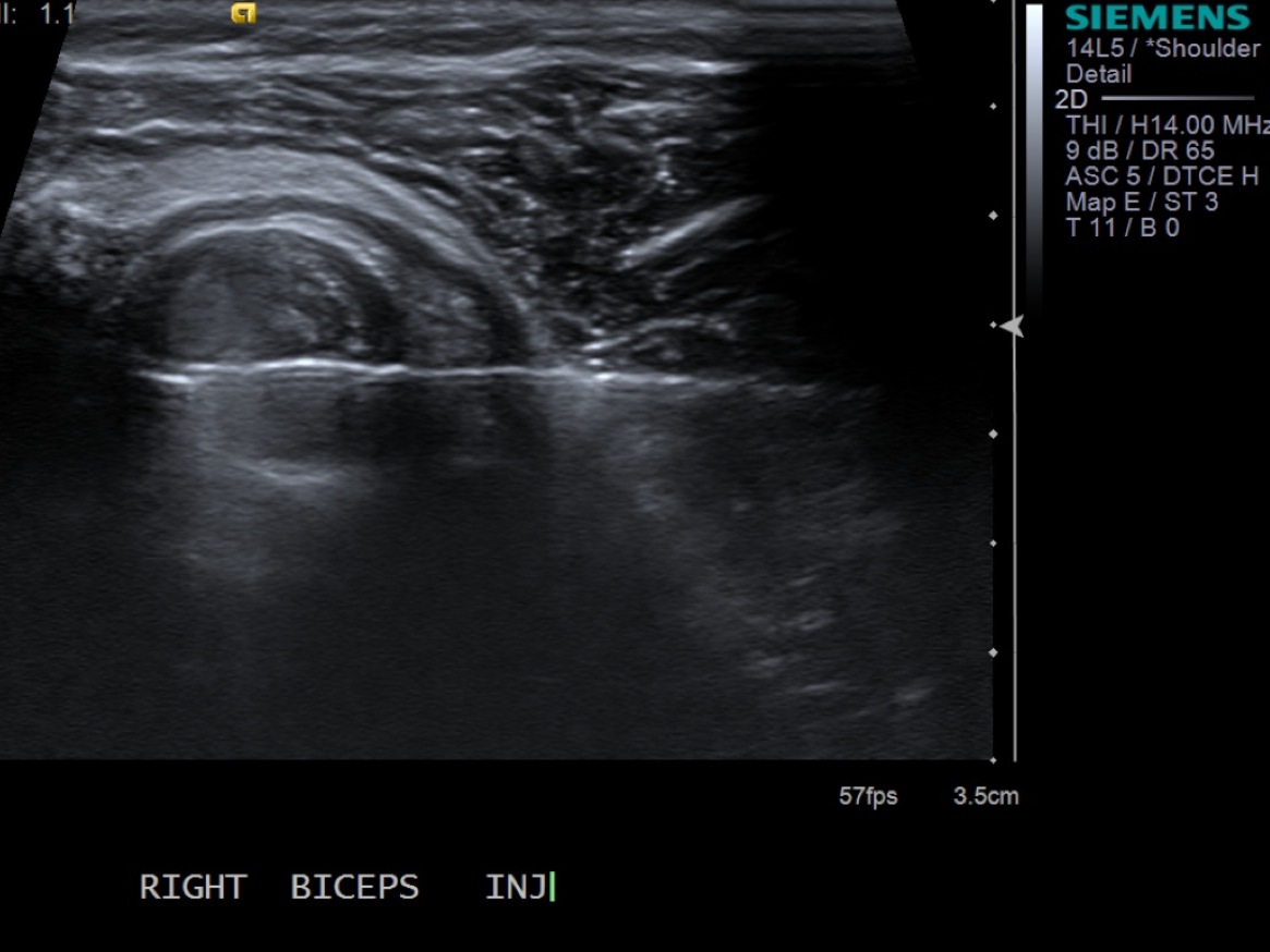 Biceps Tendon Sheath Injection — MSK Ultrasound Procedures