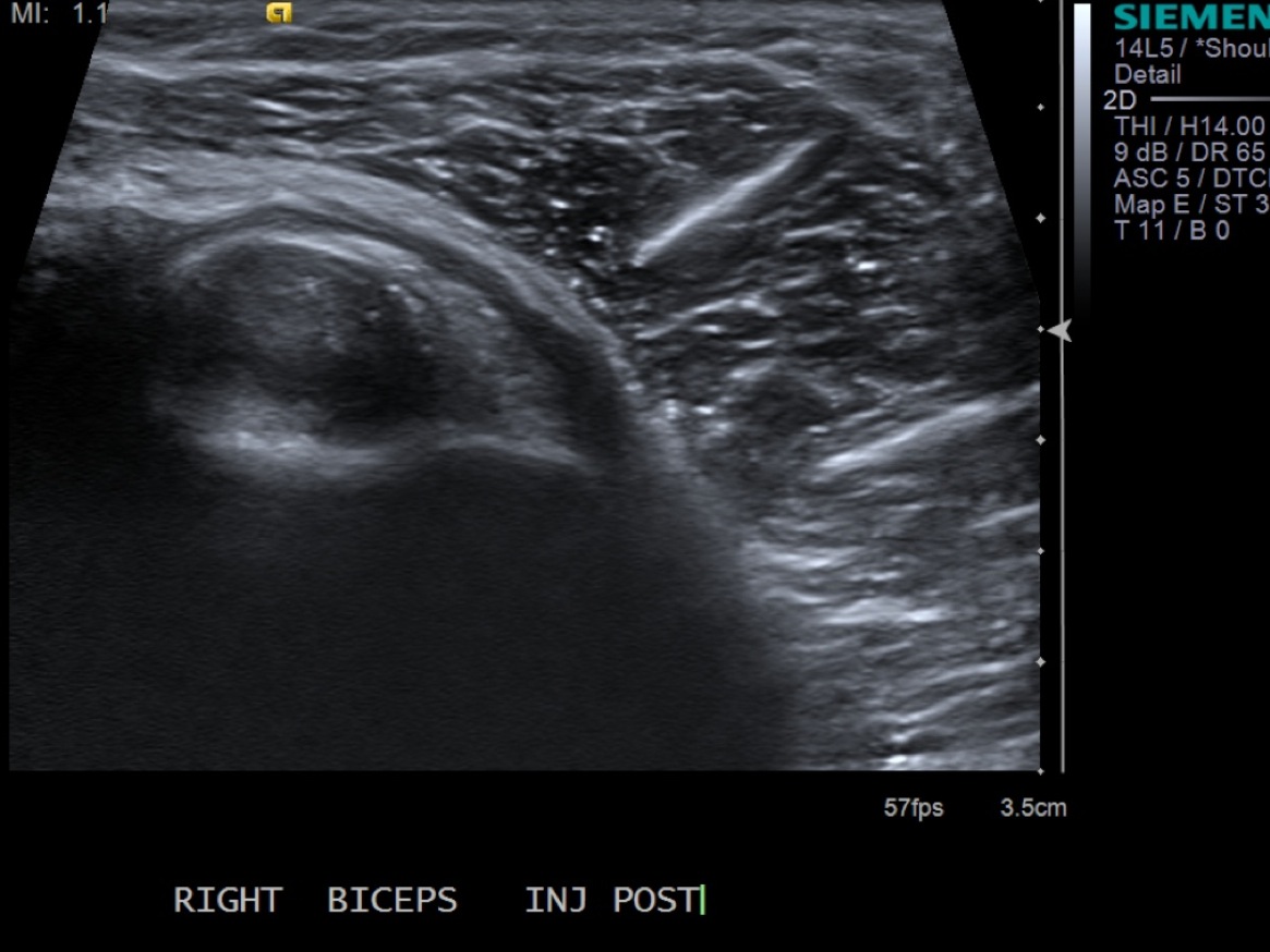 Biceps Tendon Sheath Injection — MSK Ultrasound Procedures