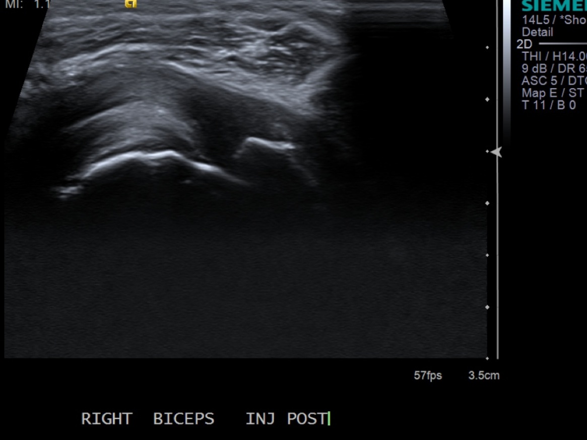 Biceps Tendon Sheath Injection — MSK Ultrasound Procedures